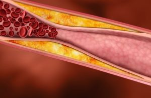 colesterol ldl alto, colesterol hdl alto, qual colesterol bom, colesterol ruim e bom, colesterol hdl é bom ou ruim, colesterol normal valor, colesterol bom hdl, colesterol total referencia, colesterol muito baixo, colesterol muito alto, colesterol e frações, colesterol qual o normal, o que colesterol alto pode causar, qual colesterol bom e ruim, o que colesterol hdl